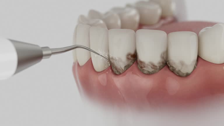 Trusted Wisdom Tooth Removal service in Alafaya, FL - Dentist Open Now
